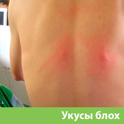 Укусы блох в Нижнем Новгороде