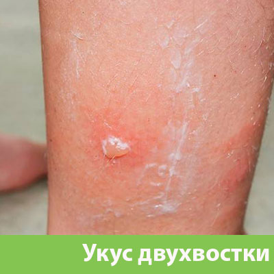 Укус двухвостки в Нижнем Новгороде