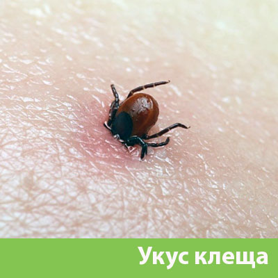 Укус клеща в Нижнем Новгороде