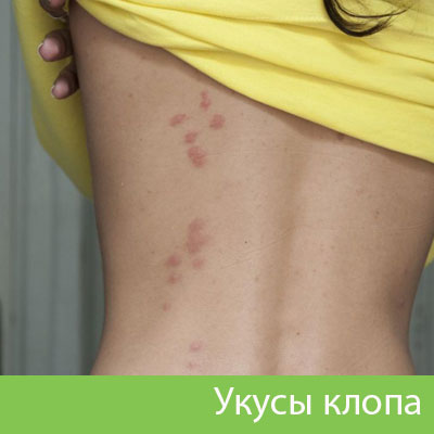 Профессиональное уничтожение клопов в Нижнем Новгороде